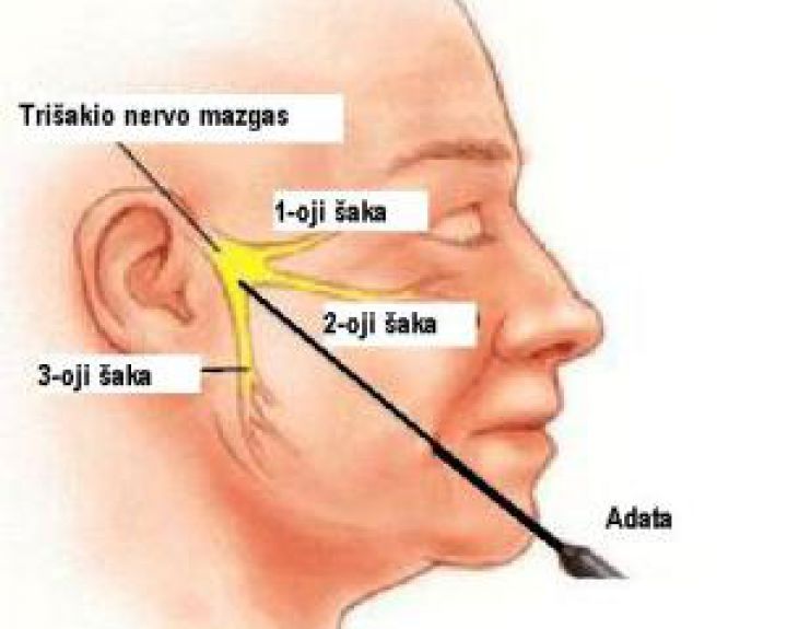 Trisakis nervas gydymas
