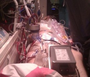 ECMO