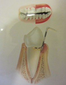 Periodontitas