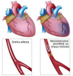 Susiaurėjusi širdies krauajgyslė 