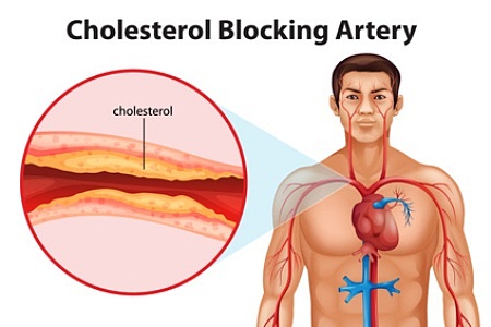 Cholesterolis
