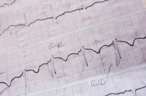 širdies kardiograma su hipertenzija