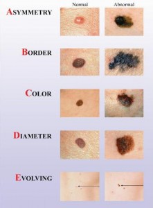 Melanoma