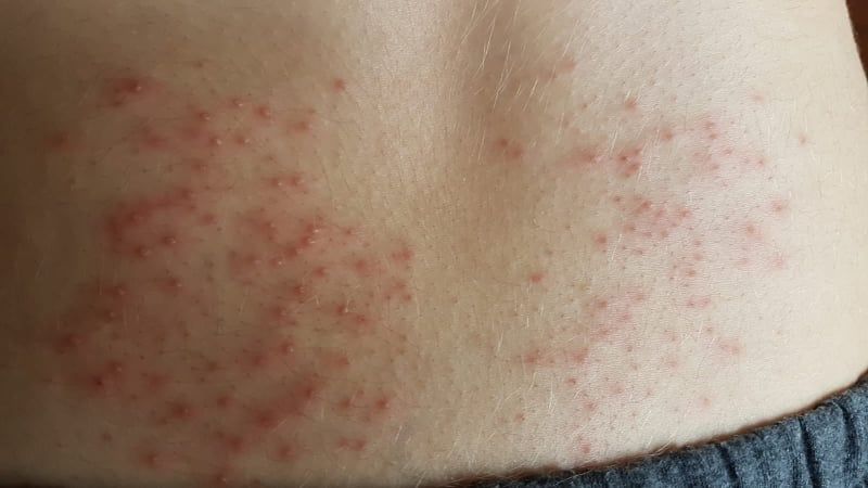 Alerginis bėrimas: kodėl pasireiškia ir kaip tai gydyti? | Gintarinė