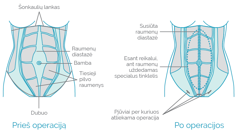 Pilvo sienos išvarža prieš operaciją ir po jos
