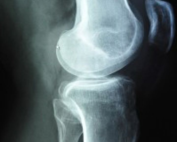 Osteoporozė ir jos profilaktika