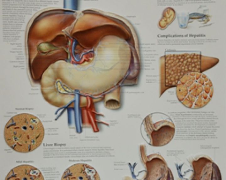 Virusinio hepatito A protrūkis Vilniaus mieste