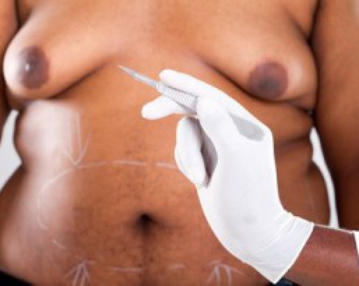 Diabeto gydymo standartas – nutukimo operacija 