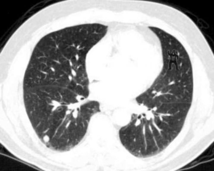 Net 83 proc. patyrusių radiologų rentgeno nuotraukoje nepastebėjo gorilos 