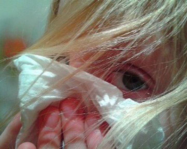 Ką daryti, kai darželyje ar mokykloje aptinkama tuberkuliozė?