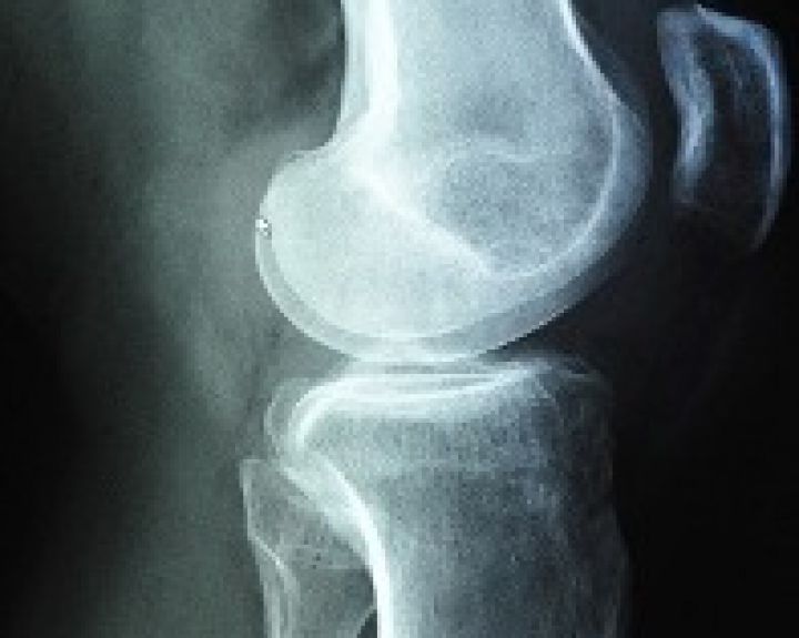 Traška sąnariai, nustatyta osteochondrozė... 