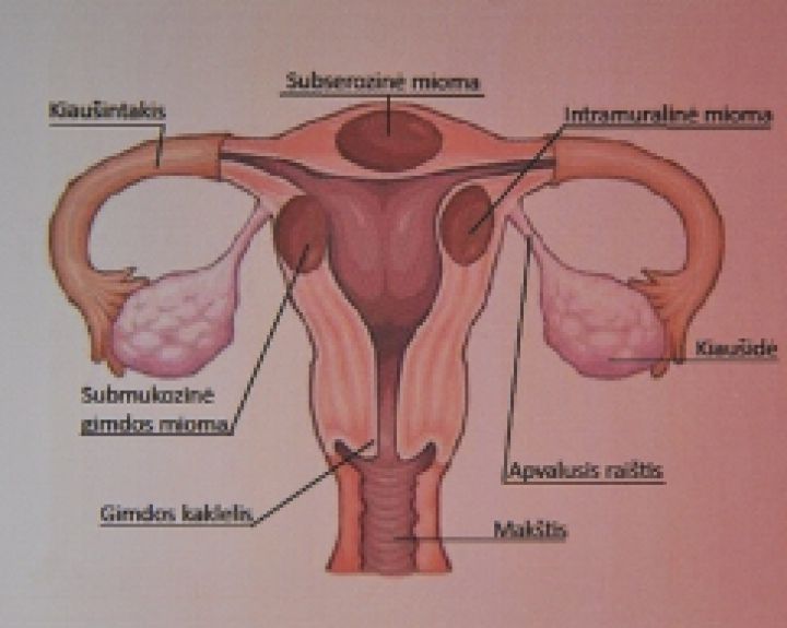 Kaip gydomas gimdos kaklelio uždegimas?