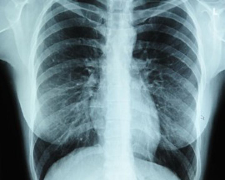 Lėtinė obstrukcinė plaučių liga: prevencija, diagnostika ir gydymas