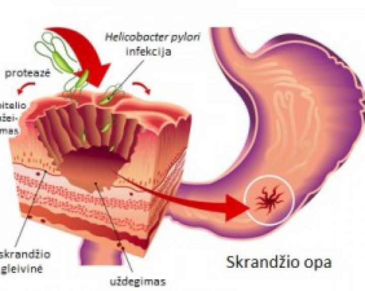 Kas yra skrandžio displazija?
