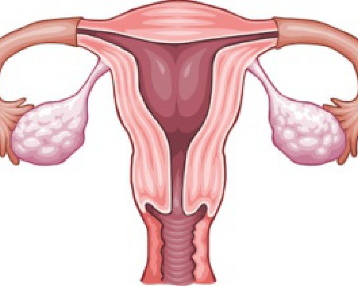 Kaip pesticidai susiję su endometrioze
