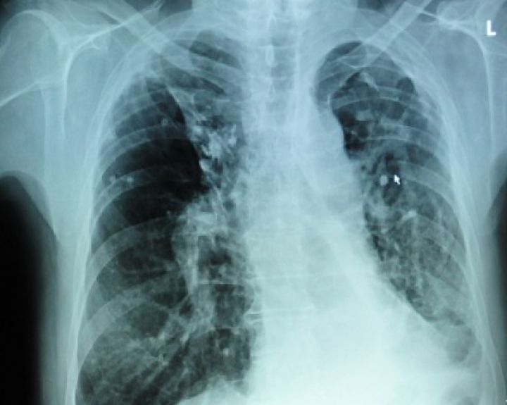 Ar prasidės Lietuvoje priverstinio tuberkuliozės gydymo era?