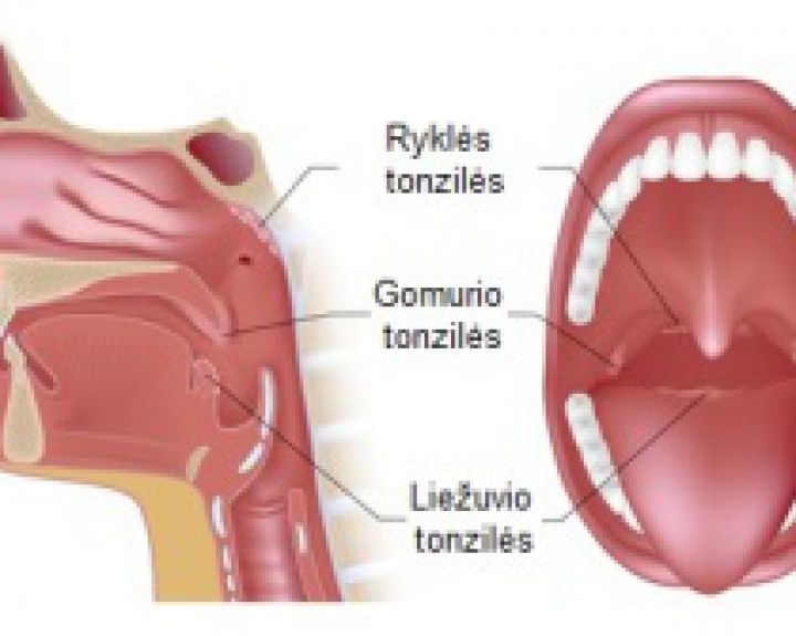 Ar yra ryšys tarp anginos ir gastroezofaginio refliukso? 