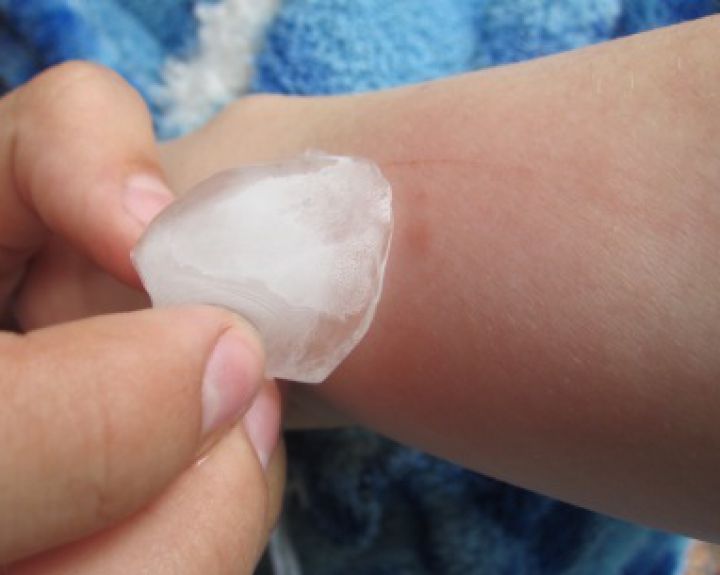 Alergija šalčiui: apie viską, ką turėtume žinoti 