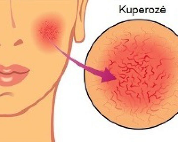 Raudona nosis. Kaip tą kuperozę išgydyti?