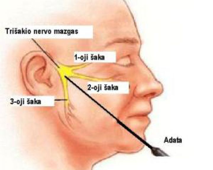 Lietuvos pacientams pradėtas taikyti naujas ir efektyvus trišakio nervo neuralgijos gydymo būdas 
