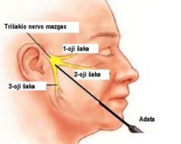 Lietuvos pacientams pradėtas taikyti naujas ir efektyvus trišakio nervo neuralgijos gydymo būdas 