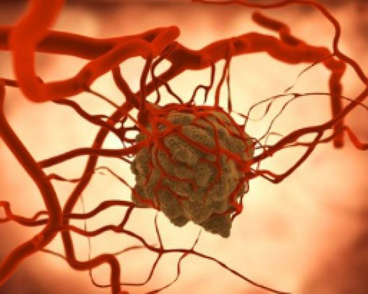 Lanreotidas efektyviai gydo neuroendokrininį vėžį