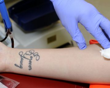 Tatuiruotes šalinantys lazeriai – ir aknės randams gydyti