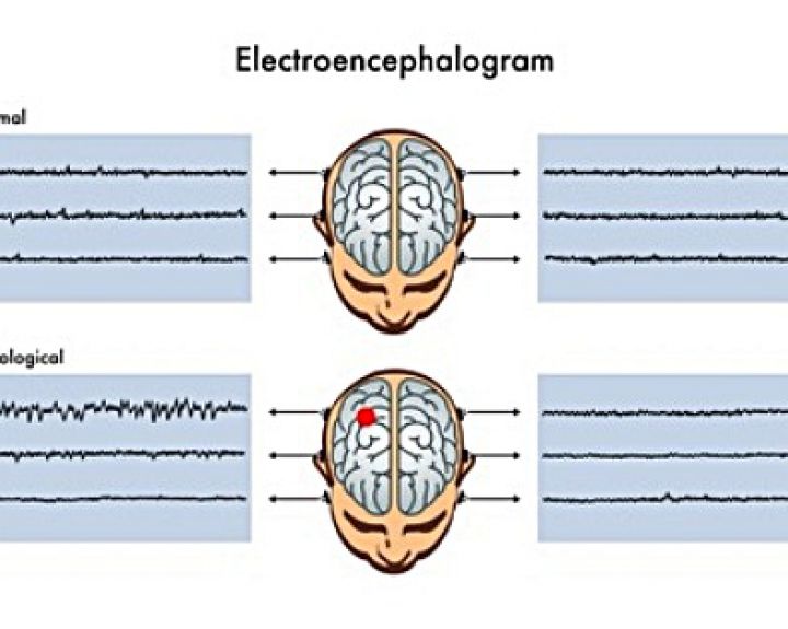Vaikų epilepsija: ar įvairialypė liga gali praeiti?