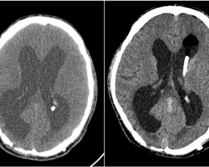 Santariškių klinikų neurochirurgai atlikto inovatyvią smegenų skysčio drenavimo operaciją 
