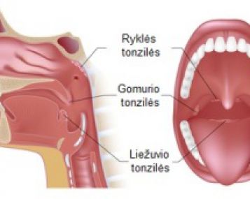 Sūnui padidėjęs ASO titras. Ar šalinti tonziles?