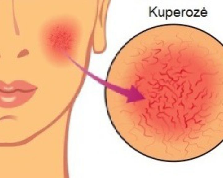 Kaip gydyti rožinę nėštumo metu? 