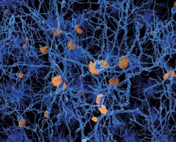 Alzheimerio ligą bandys gydyti žemo dažnio garsais