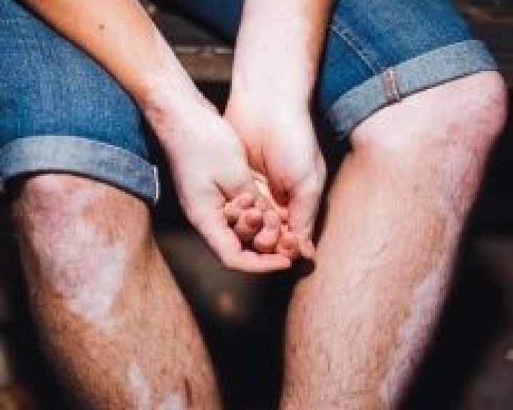    Baltmė: kodėl ji vis dar stigmatizuojama