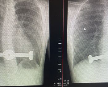 Įdubusiai krūtinės ląstai gydyti pirmąsyk panaudotas naujausias metodas