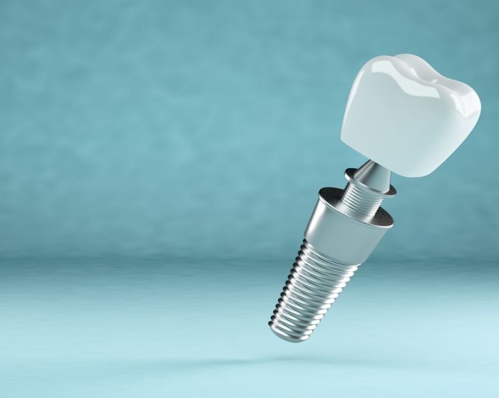 Dantų implantavimas - geriausias pasirinkimas gražios šypsenos link   