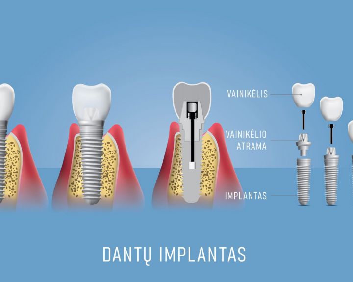 Dantų implantavimas Vilniuje: dantų praradimas šiandien – ne pabaiga