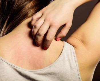 Neišgydomas ir neišvengiamas atopinis dermatitas: svarbi bakterijų pusiausvyra