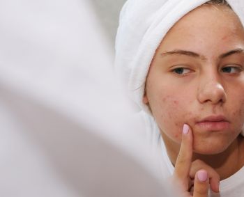 Aknė: patarimai, padėsiantys pagerinti odos būklę