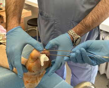 Sergančiuosius diabetu nemokamai tikrins dėl diabetinės pėdos   