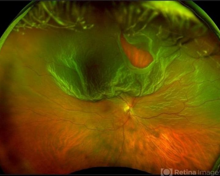Žaibavimas akyse gali būti aklumu gresiančios ligos pranašas