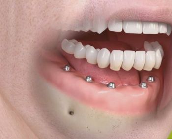 Nuo išimamų protezų iki implantų: kaip susigrąžinti šypseną ir gyvenimo kokybę