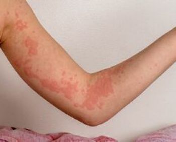 Erkės gali sukelti gyvybei pavojingą alergiją mėsai