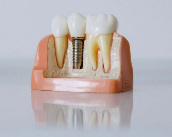 Dantų implantacija: ar gali būti biudžetinis variantas?