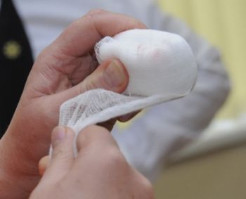 Nauja technologija užkirs kelią randams atsirasti