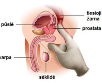 Prostatos sutrikimai: simptomus atpažinti lengva, svarbu tik nesigėdyti