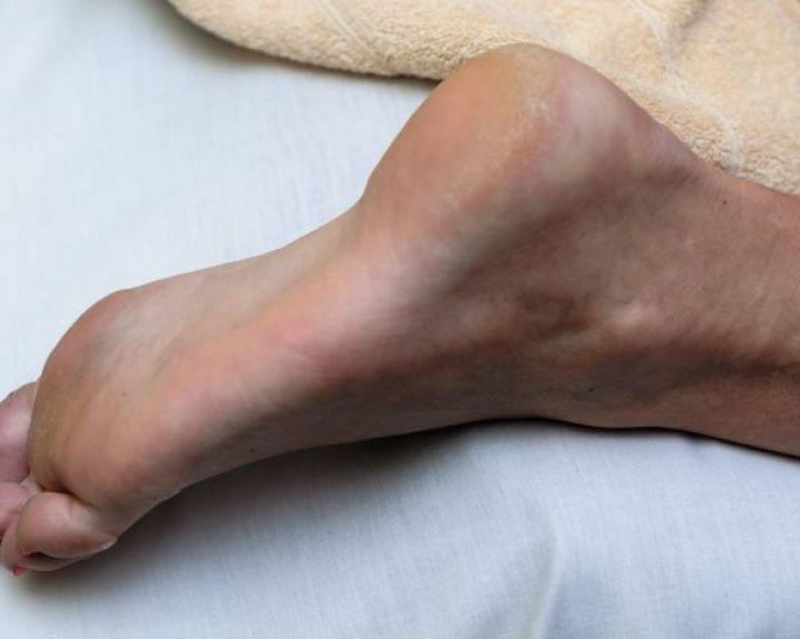 Pūslelės ir nuospaudos ant pėdų: kuo jos skiriasi bei kaip jas gydyti?