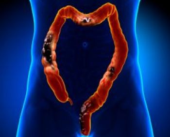 Kas antras susirgęs miršta, nors laiku diagnozavus ligą galėjo išgyventi